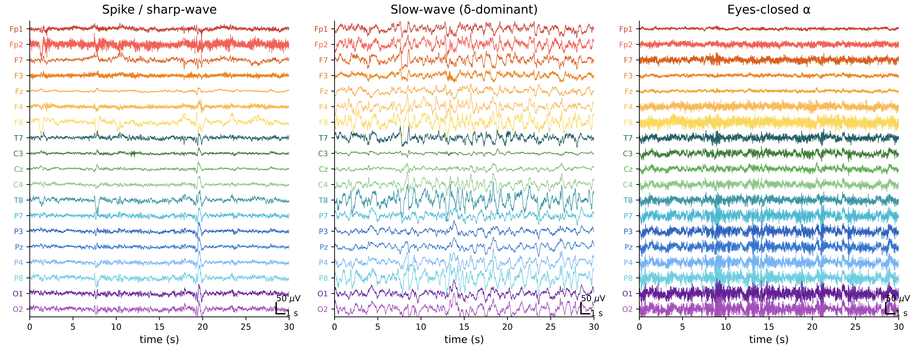Three B[FM]2 samples: a sharp-wave transient, delta slow-wave activity, and posterior alpha rhythm.